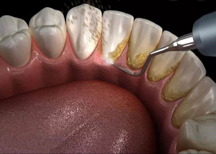 Зубной камень и кровоточивостью дёсен