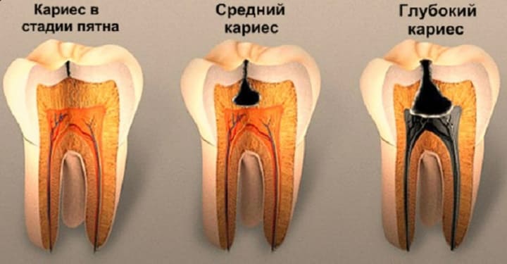 Реакция зубов на сладкое, кислое, горячее и холодное