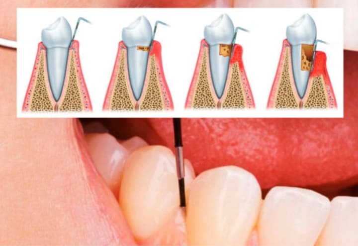 Воспаление пародонтального кармана